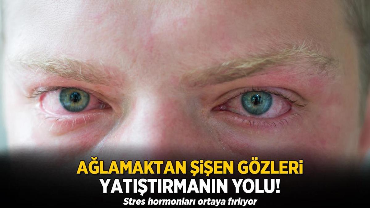 Ağlamaktan şişen gözleri yatıştırmanın yolu! Stres hormonları ortaya fırlıyor